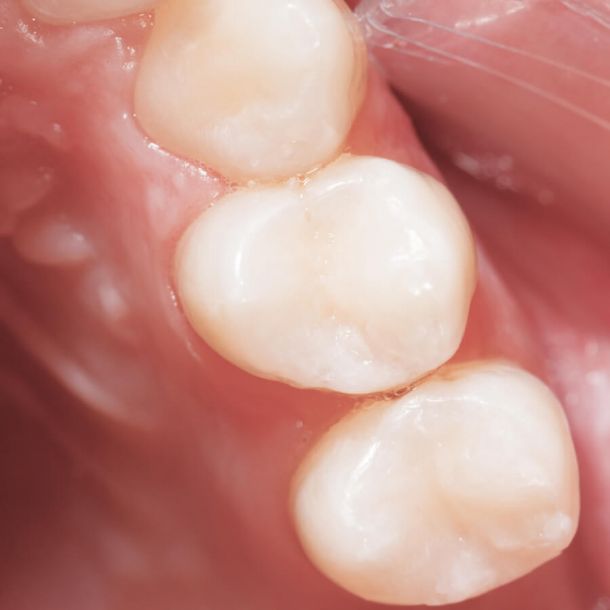 Zahnrestauration mit Komposit