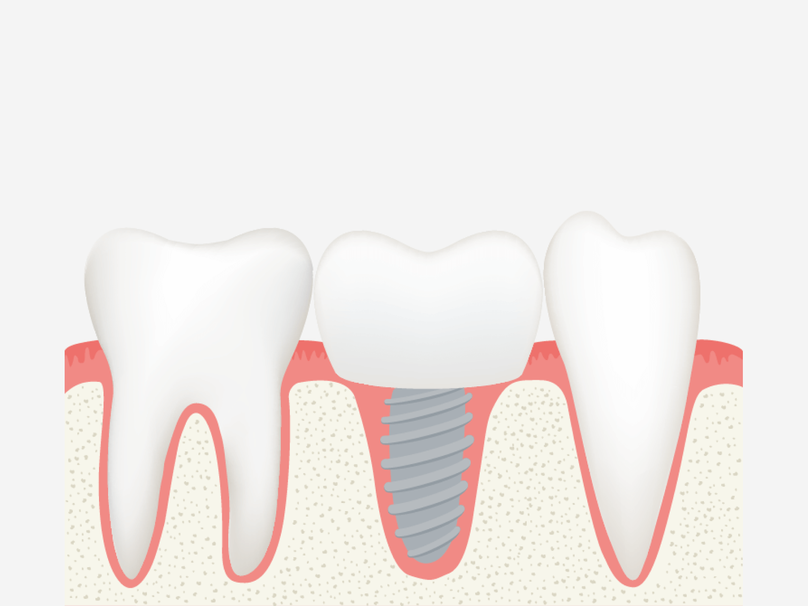 Implantat Ablauf: Abbildung 4: vollständigt gefüllte Zahnlücke