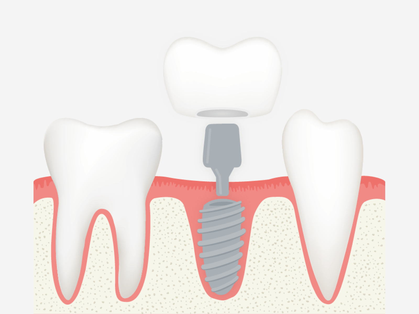 Implantat Ablauf: Abbildung 3: Implantatkörper mit Abutment und Zahnkrone
