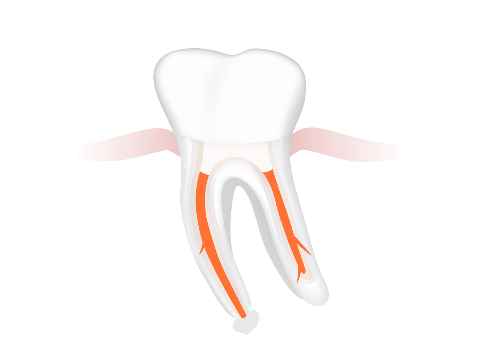 Aufgebauter Zahn mit Composit, Krone oder Brücke