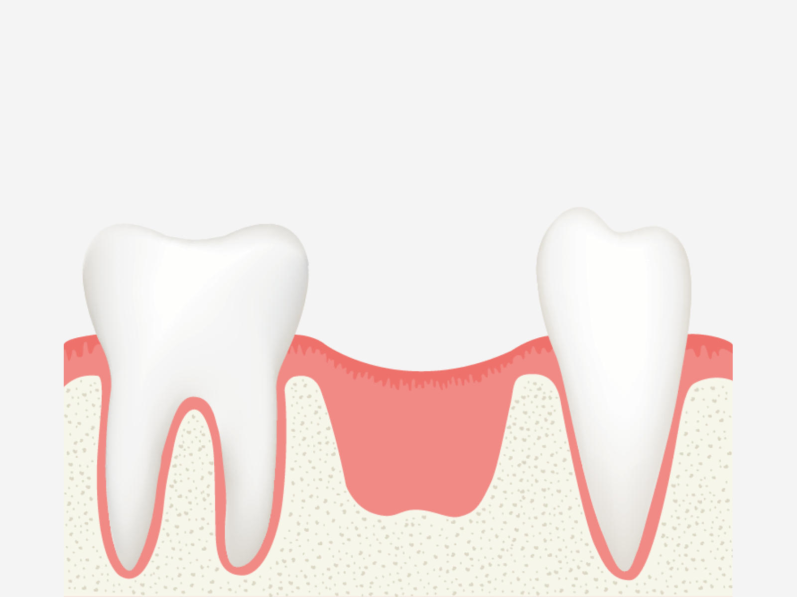 Implantat Ablauf: Abbildung 1: Zahnlücke